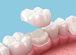 Custom Ceramic Crowns
